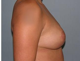 Breast Reduction Before & After Patient #8413