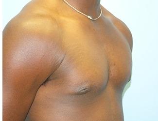 Gynecomastia Before & After Patient #8443