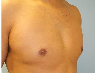 Gynecomastia Before & After Patient #8441