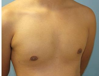 Gynecomastia Before & After Patient #8439