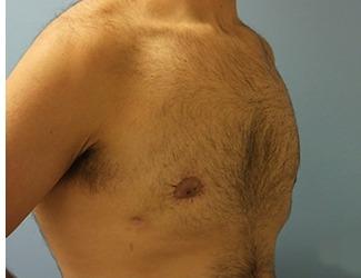 Gynecomastia Before & After Patient #8435