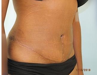 Tummy Tuck Before & After Patient #8192
