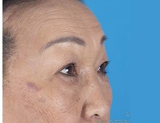 Browlift Before & After Patient #8457