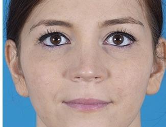 Rhinoplasty Before & After Patient #8809