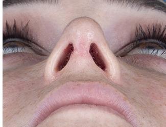 Rhinoplasty Before & After Patient #8808