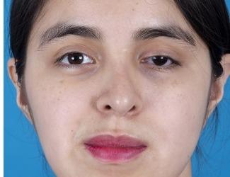 Rhinoplasty Before & After Patient #8807