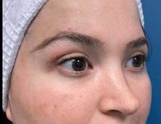 Blepharoplasty Before & After Patient #8485