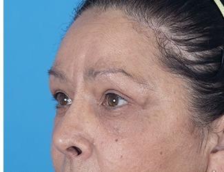 Blepharoplasty Before & After Patient #8484