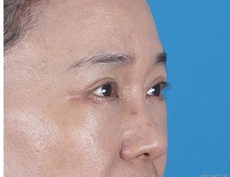 Blepharoplasty Before & After Patient #8483