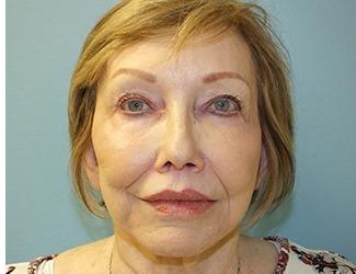 Lip Lift Before & After Patient #8800