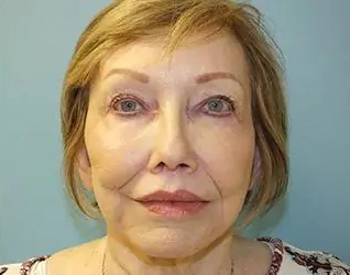 Lip Lift Before & After Patient #8800
