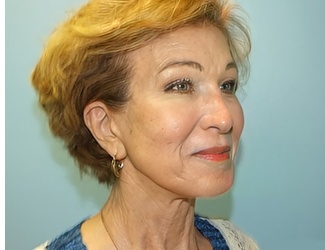 Facial Fat Grafting Before & After Patient #8745