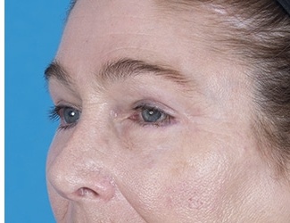 Facial Fat Grafting Before & After Patient #8748