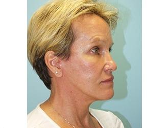 Facial Fat Grafting Before & After Patient #8741