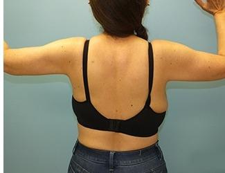 Arm Lift Before & After Patient #4690