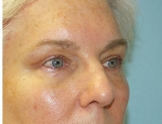 Facial Fat Grafting Before & After Patient #8744