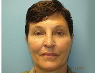 Facial Fat Grafting Before & After Patient #8742