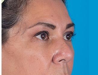 Facial Fat Grafting Before & After Patient #8743