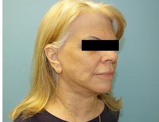 Facial Fat Grafting Before & After Patient #8740
