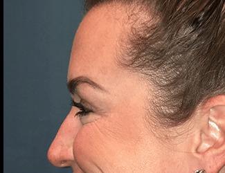 Botox Before & After Patient #8821