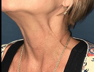 Botox Before & After Patient #8820