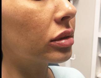 Jeuvederm Before & After Patient #8824