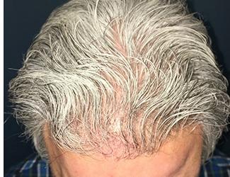 NeoGraft Before & After Patient #8826