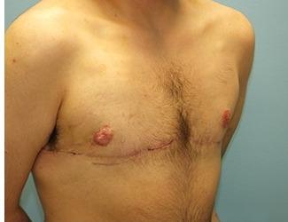 Female to Male Before & After Patient #8442