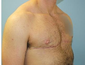 Female to Male Before & After Patient #8440