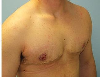 Female to Male Before & After Patient #8444