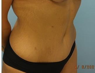 Tummy Tuck Before & After Patient #8197