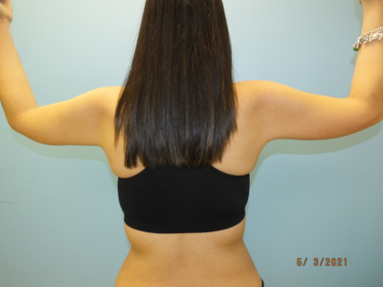 Arm Lift Before & After Patient #4821