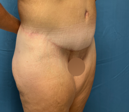 Lower Body Lift Before & After Patient #8028