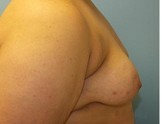 Female to Male Before & After Patient #8437