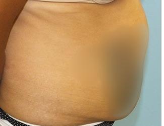 Tummy Tuck Before & After Patient #8199