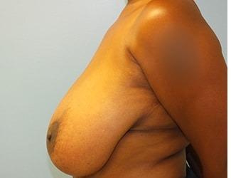 Breast Reduction Before & After Patient #8416