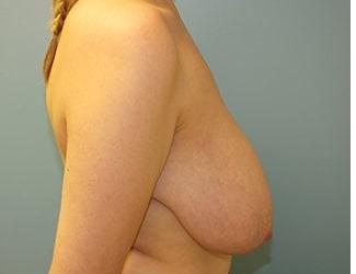 Breast Reduction Before & After Patient #8417