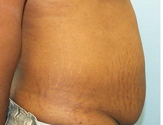Tummy Tuck Before & After Patient #8195