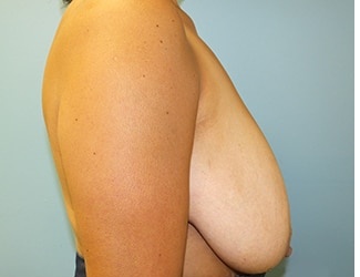 Breast Reduction Before & After Patient #8410