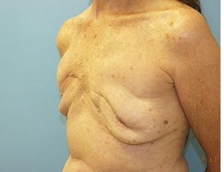 Breast Revision Before & After Patient #8240