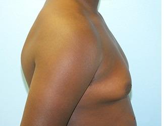 Gynecomastia Before & After Patient #8443