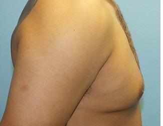 Gynecomastia Before & After Patient #8441