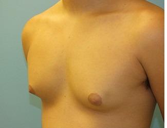 Gynecomastia Before & After Patient #8439
