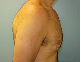 Gynecomastia Before & After Patient #8435