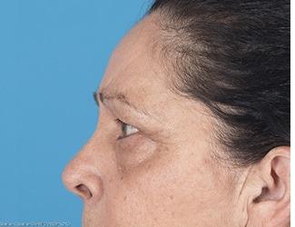 Browlift Before & After Patient #8461