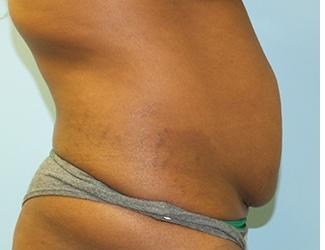 Tummy Tuck Before & After Patient #8192