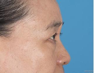 Browlift Before & After Patient #8460