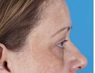 Browlift Before & After Patient #8458
