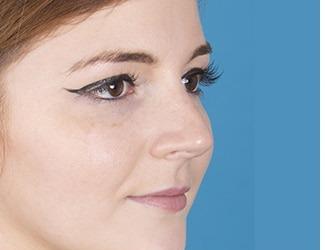 Rhinoplasty Before & After Patient #8809