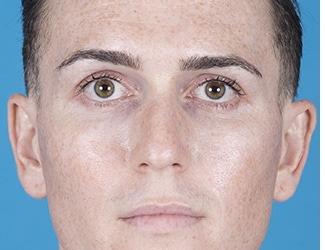 Rhinoplasty Before & After Patient #8808